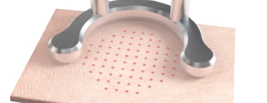 Extinkt laser tattoo removal sydney skin rejuvenation process