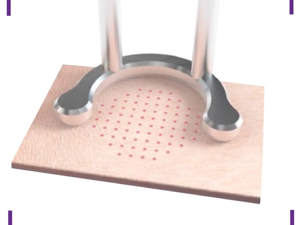 Extinkt laser tattoo removal sydney skin rejuvenation process