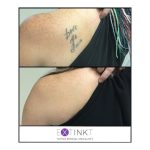 tattoo removal on left shoulder