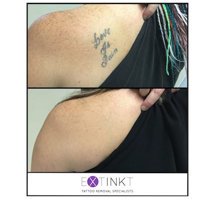 tattoo removal on left shoulder
