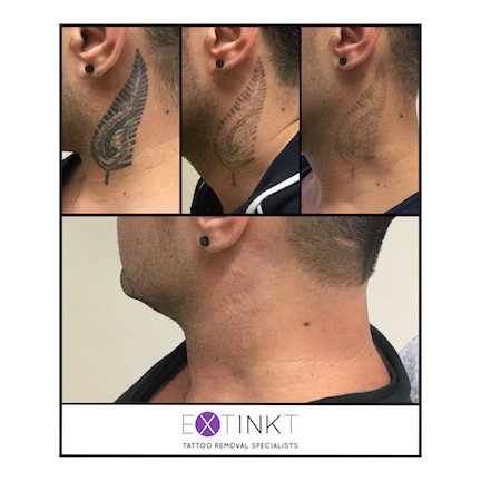 completed tattoo removal result in our clinic