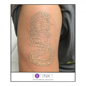 second image for tattoo removal interactive slider