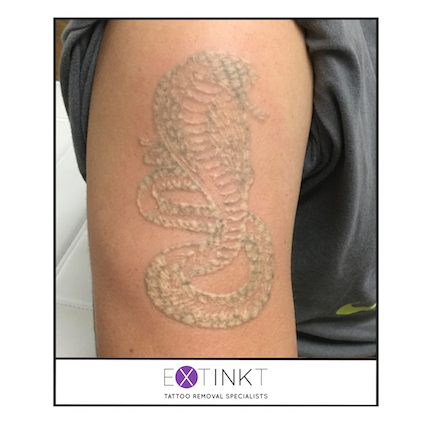second image for tattoo removal interactive slider