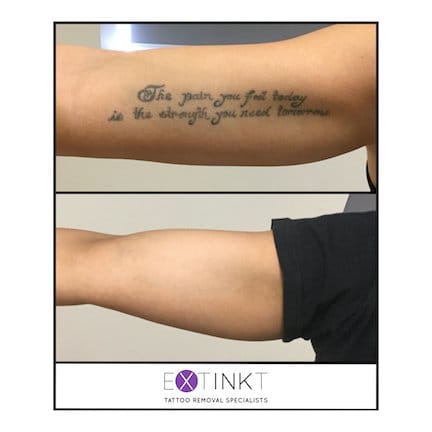 completed tattoo removal image
