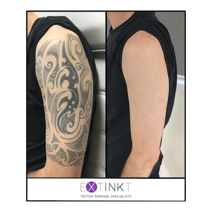 Tattoo Removal Before and After Pictures