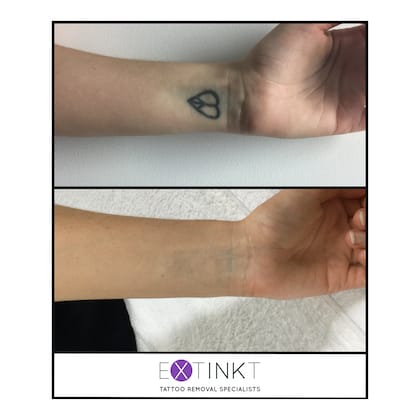 Starting Over: What You Should Know About Tattoo Removal: Holladay  Dermatology & Aesthetics: Dermatology and Aesthetic Specialists